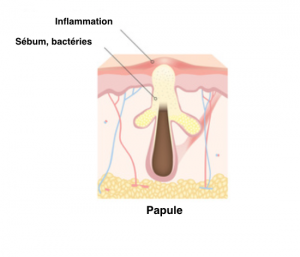 papule