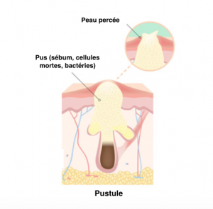 pustule